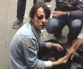 Jornalista Giuliana Vallone, do jornal “Folha de S.Paulo” ferida durante protesto em São Paulo não sofreu danos em olho afetado 